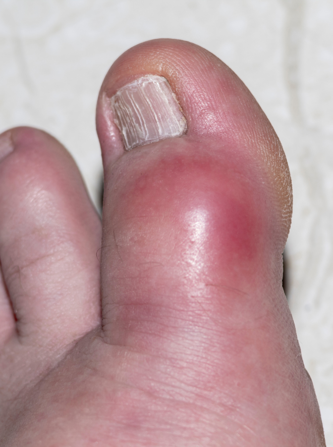 Consulta con especialista en artritis por gota